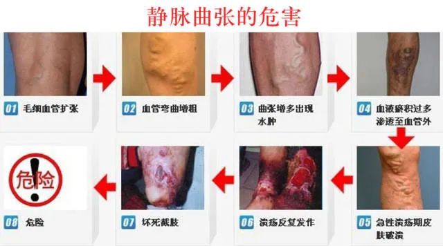 静脉曲张：.jpg